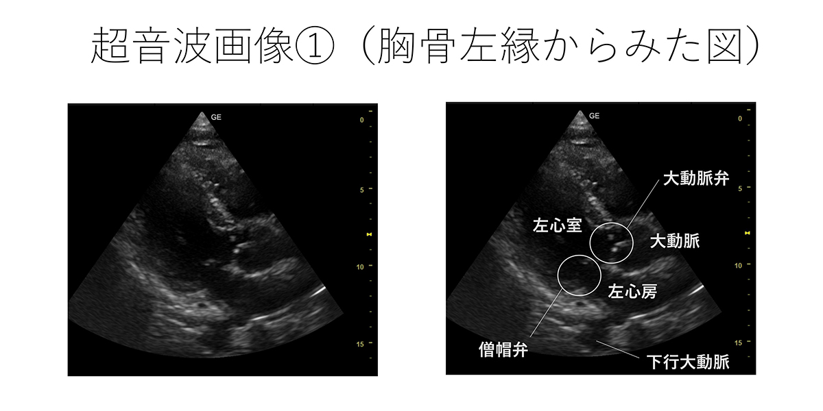 超音波画像①（胸骨左縁からみた図）
