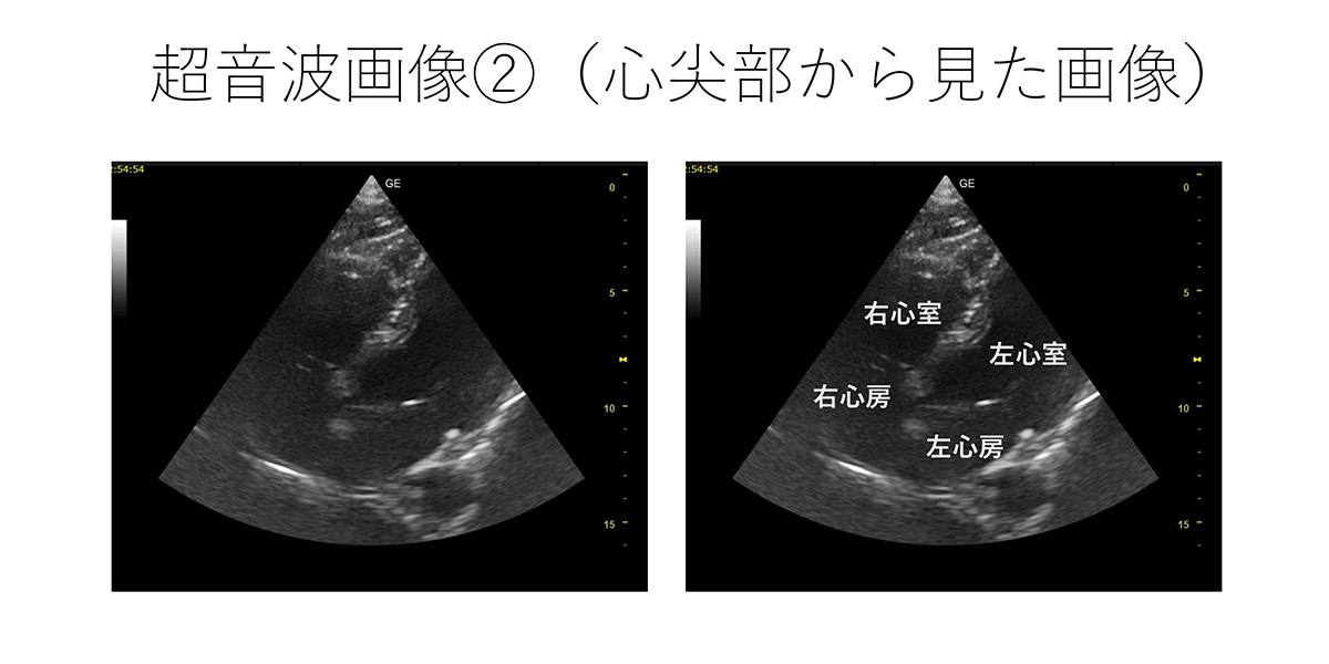 超音波画像②（心尖部から見た画像）