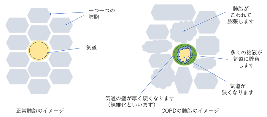 COPDの肺胞イメージ