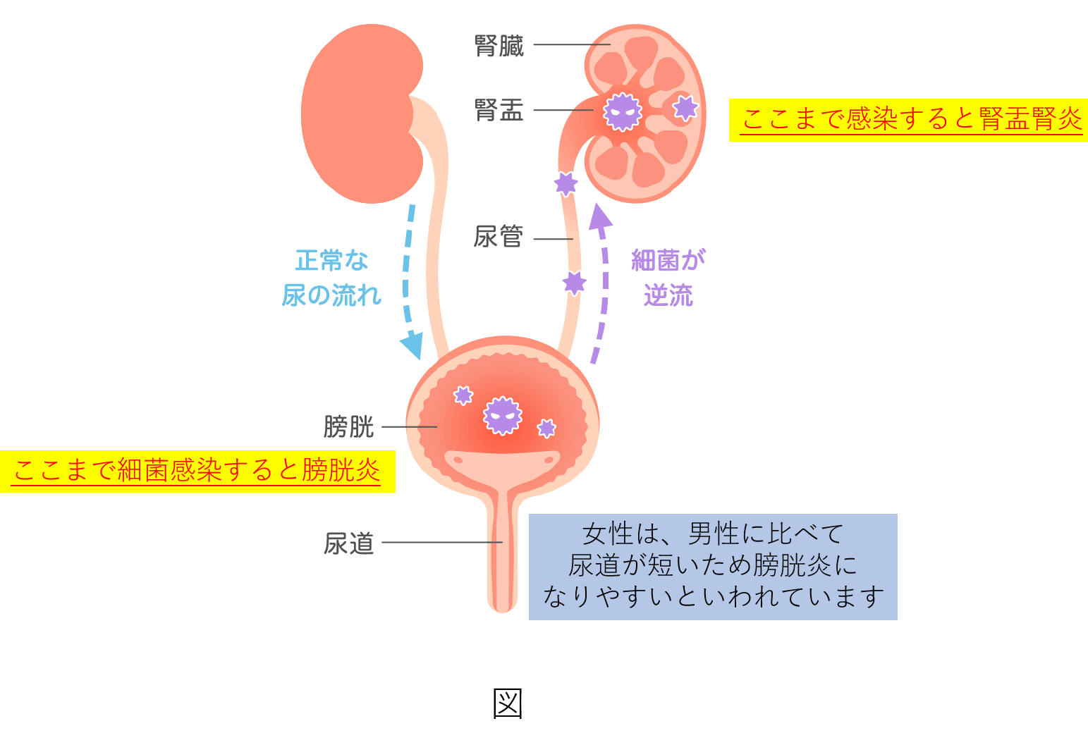 膀胱炎・腎盂腎炎のイラスト図
