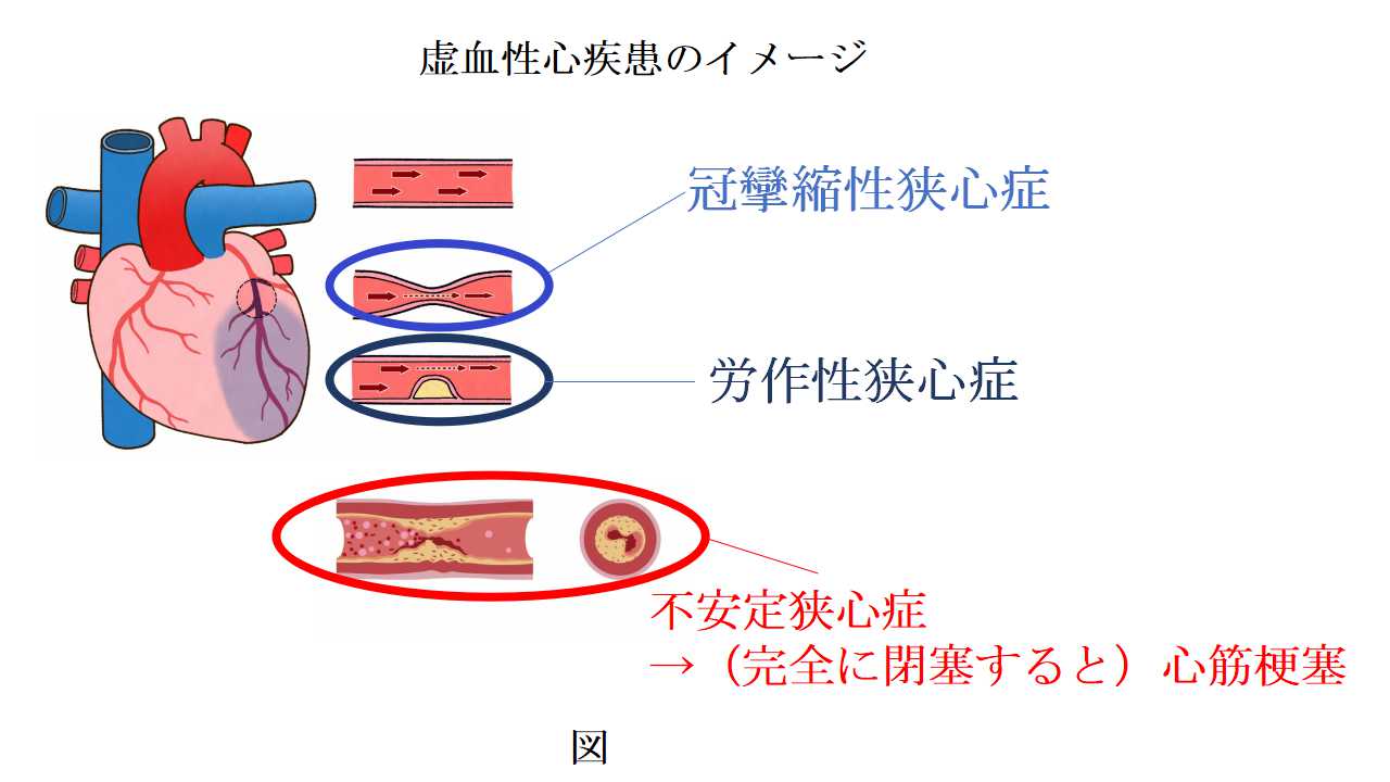 虚血性心疾患のイメージ